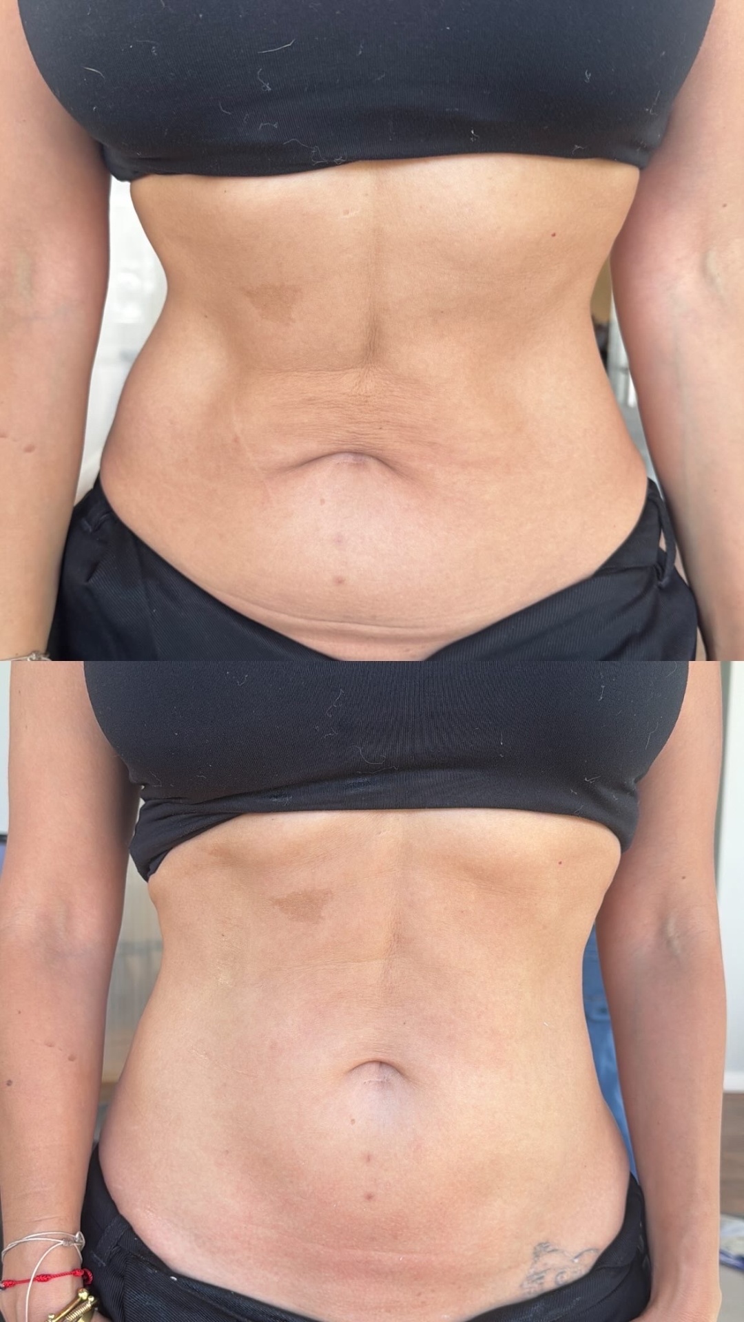 Before and after skin tightening result 4