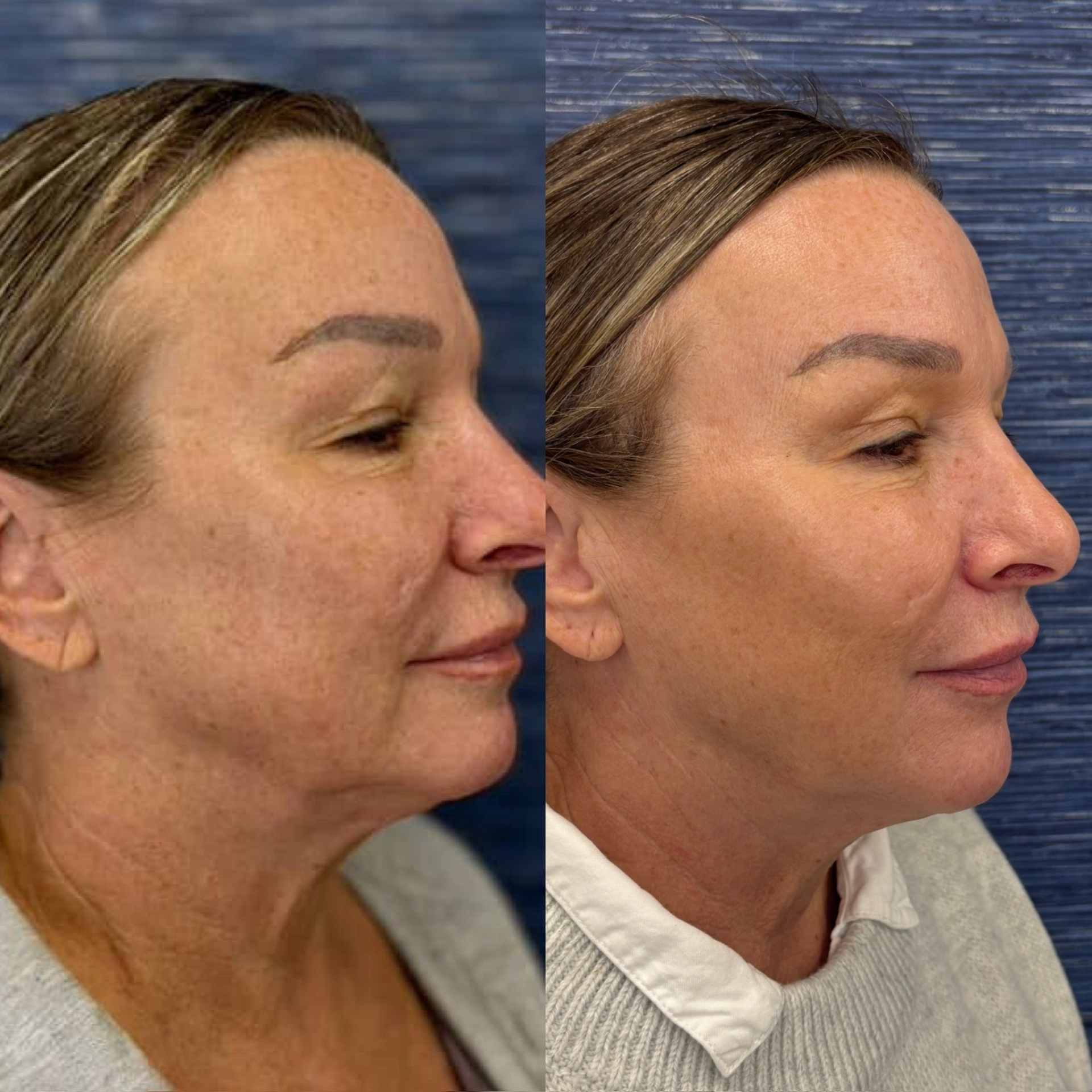 Before and after skin tightening result 2