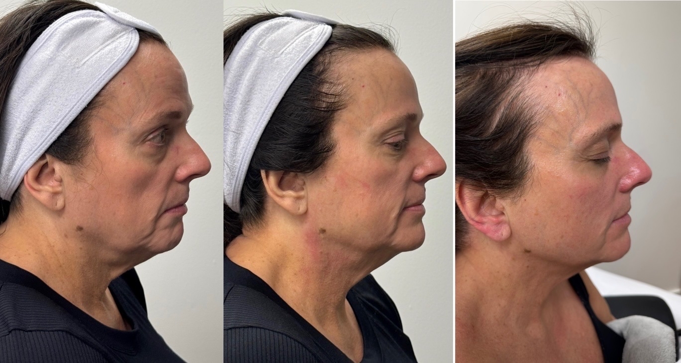 Before and after skin tightening result 1