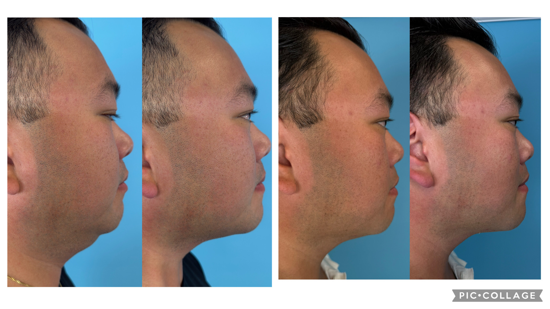 Before and after skin tightening result 5